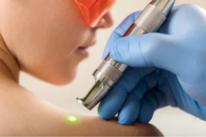 A gloved hand aiming a low-level laser at a patient's shoulder